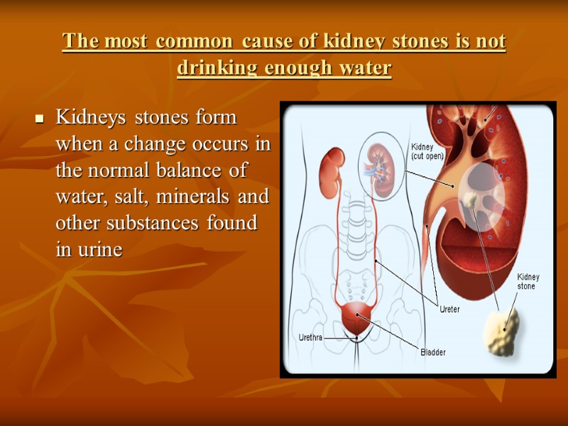 The most common cause of kidney stones is not drinking enough water Kidneys stones